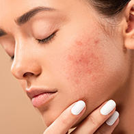 ACNE & ACNE SCAR TREATMENTS